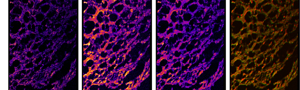 FIBROSARCOMA_2